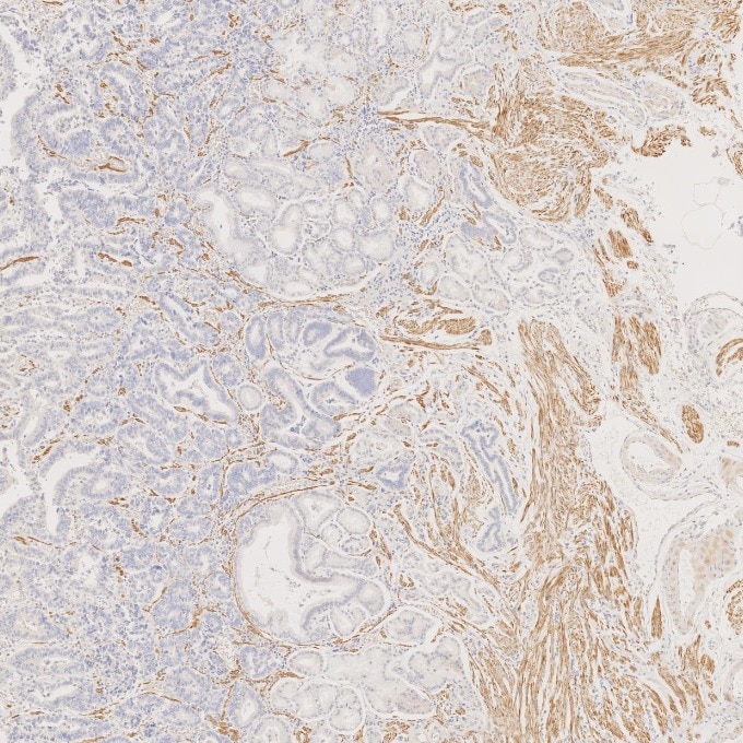 Immunohistochemistry (IHC) staining of human stomach cancer tissue using Desmin Monoclonal antibody (67793-1-Ig)