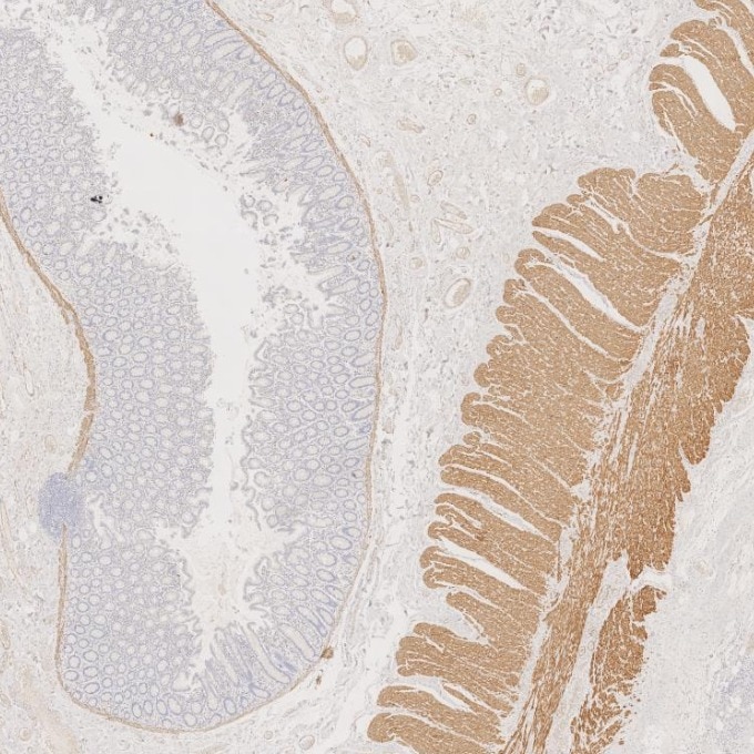 Immunohistochemistry (IHC) staining of human colorectal cancer tissue using Desmin Monoclonal antibody (67793-1-Ig)