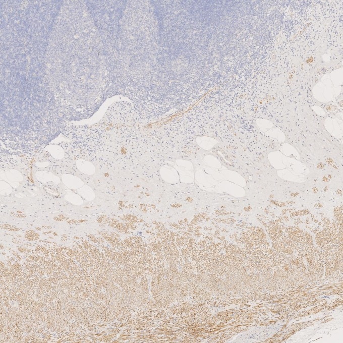 Immunohistochemistry (IHC) staining of human appendicitis tissue using Desmin Monoclonal antibody (67793-1-Ig)