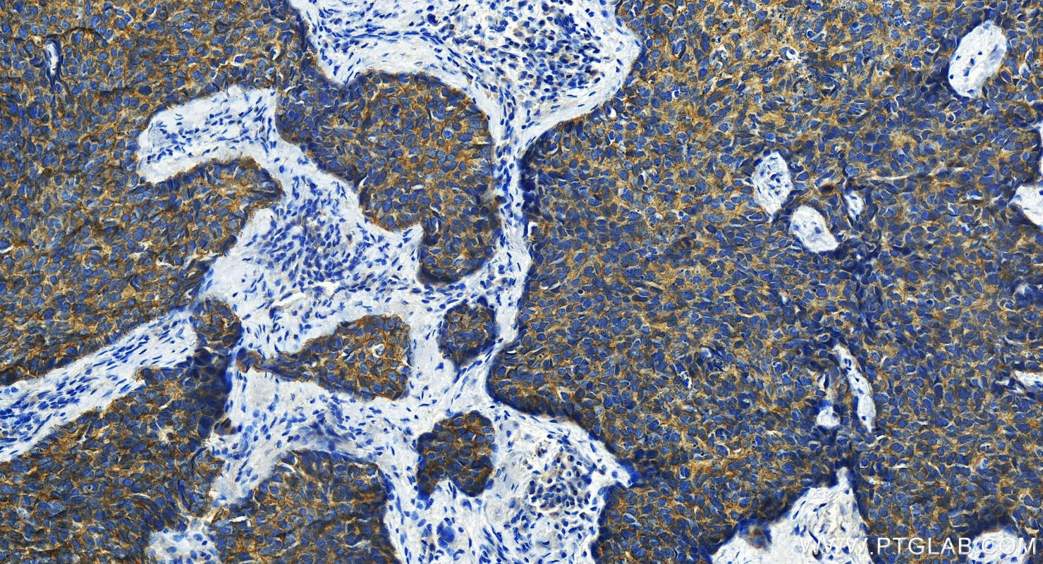 Immunohistochemistry (IHC) staining of human bowen disease using Desmoplakin Polyclonal antibody (25318-1-AP)