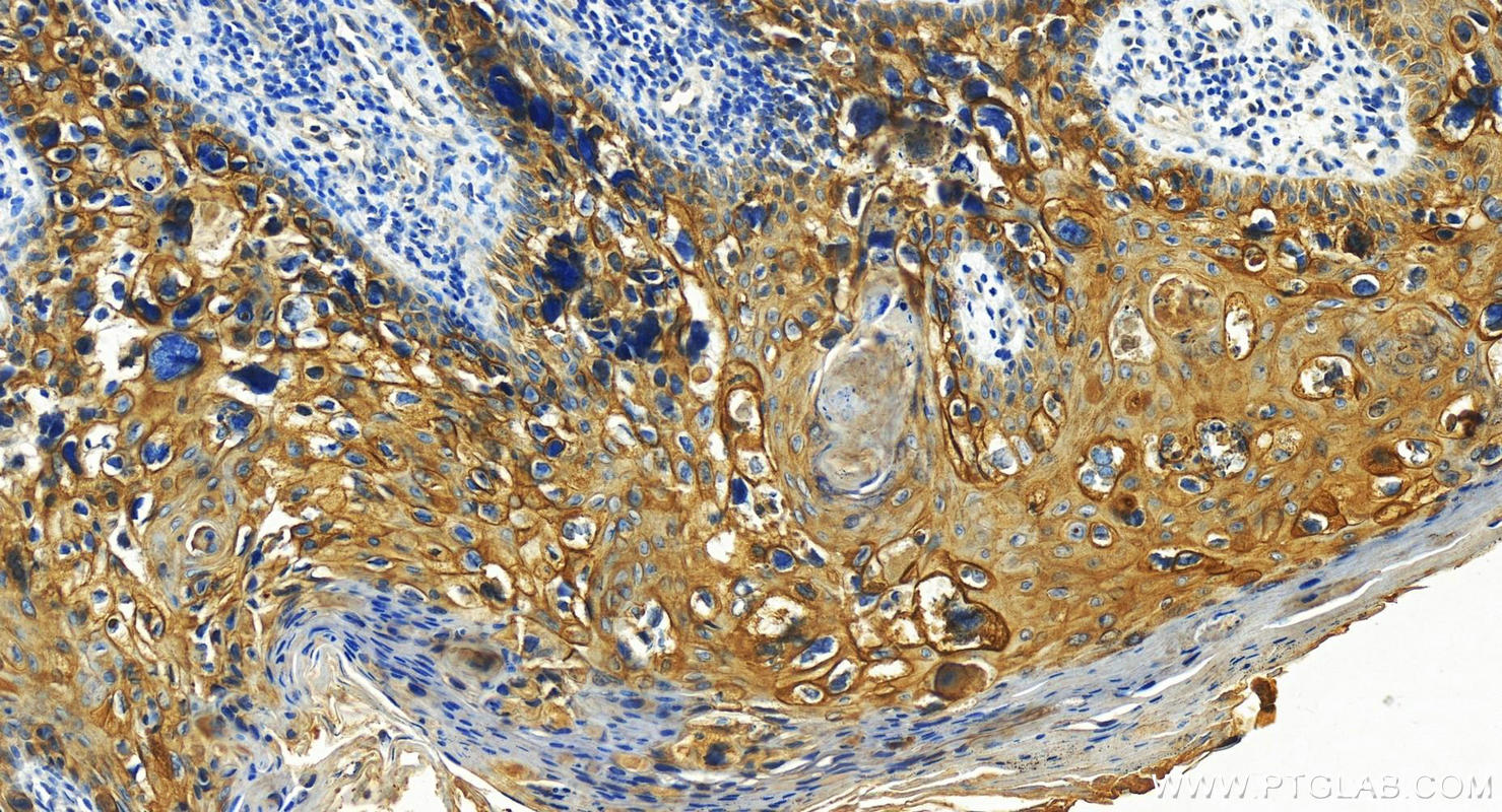 Immunohistochemistry (IHC) staining of human bowen disease using Desmoplakin Polyclonal antibody (25318-1-AP)