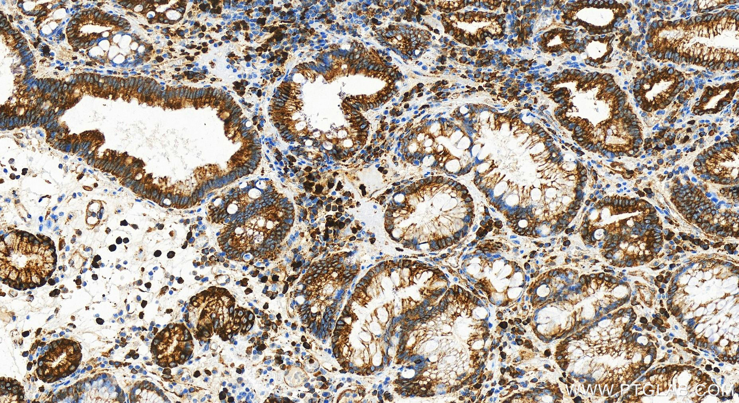 Immunohistochemistry (IHC) staining of human stomach cancer tissue using Drebrin Recombinant antibody (83591-2-RR)