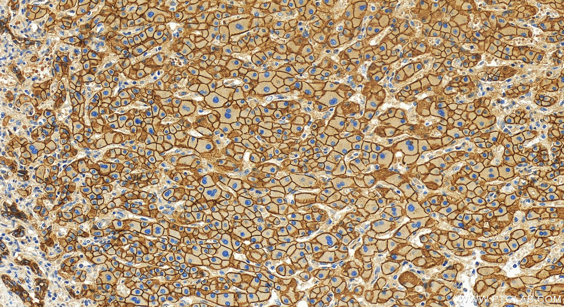 Immunohistochemistry (IHC) staining of human intrahepatic cholangiocarcinoma tissue using E-cadherin Polyclonal antibody (31515-1-AP)