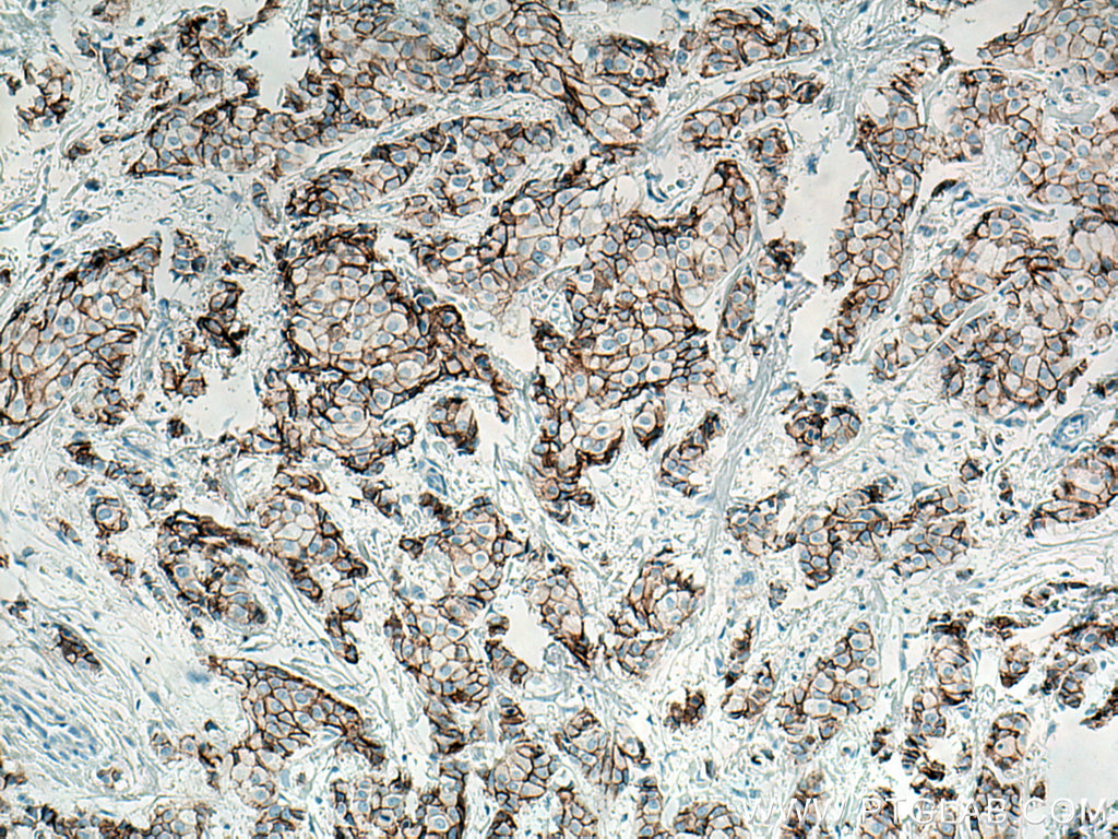 Immunohistochemistry (IHC) staining of human breast cancer tissue using E-cadherin Monoclonal antibody (60335-1-Ig)