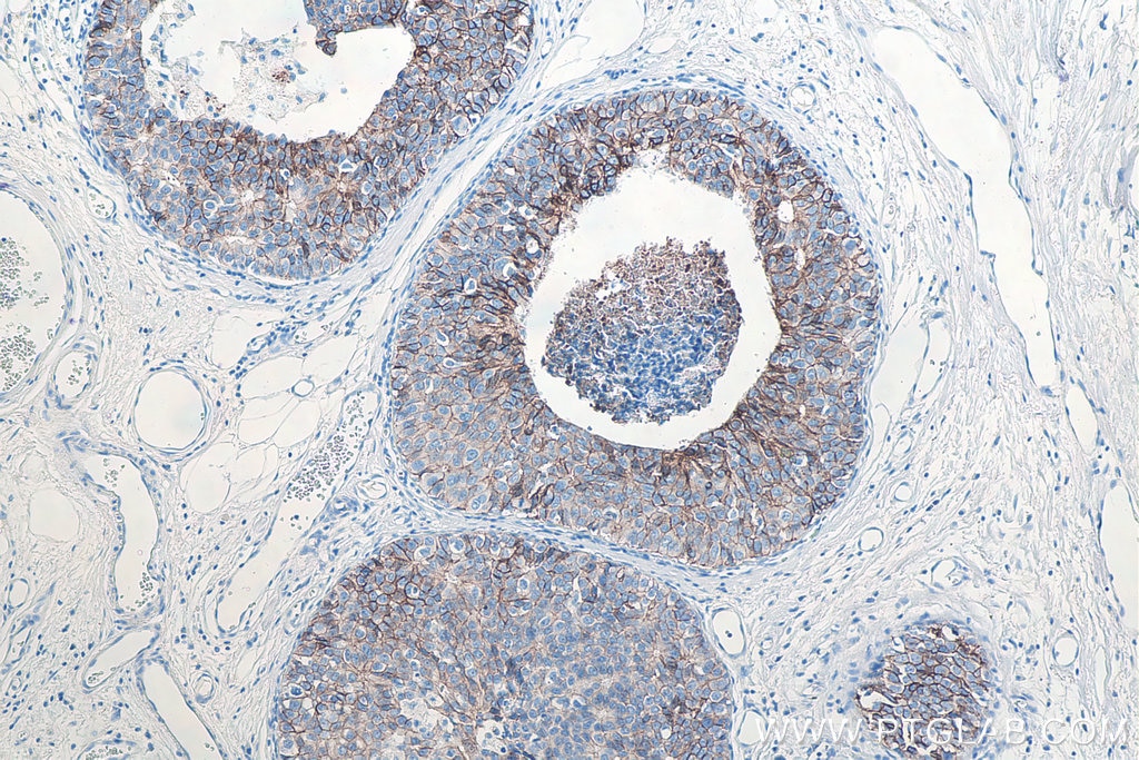 Immunohistochemistry (IHC) staining of human breast cancer tissue using E-cadherin Monoclonal antibody (60335-1-Ig)