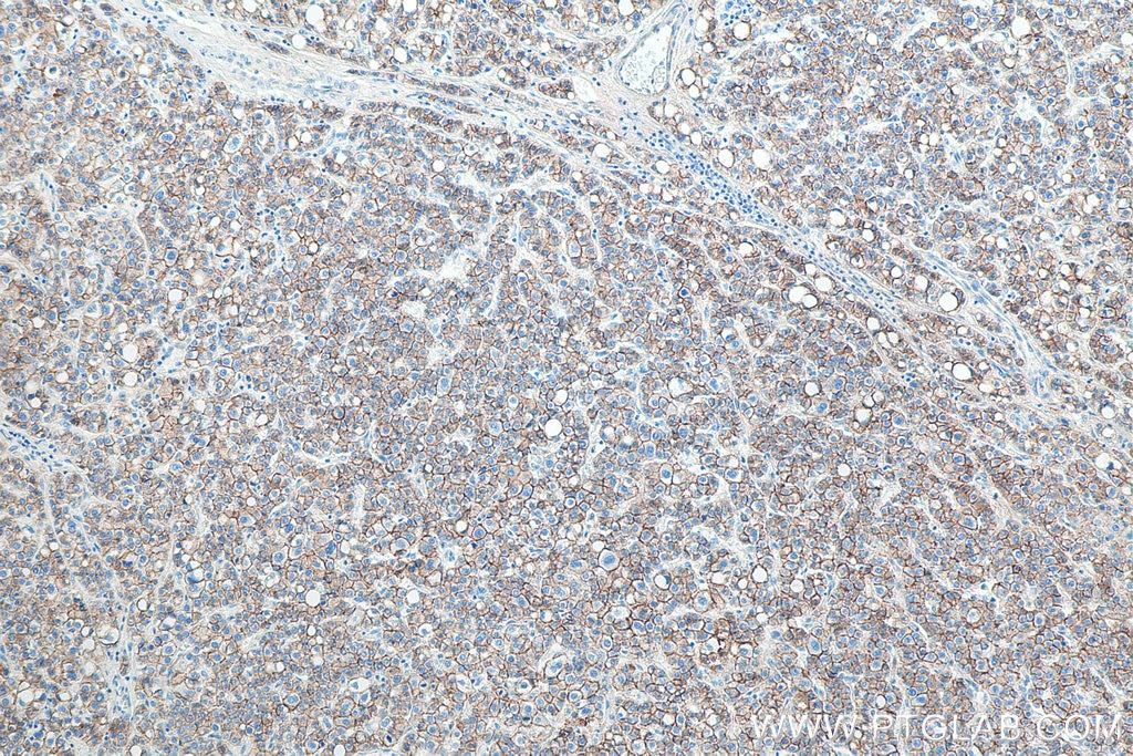 Immunohistochemistry (IHC) staining of human liver cancer tissue using E-cadherin Monoclonal antibody (60335-1-Ig)