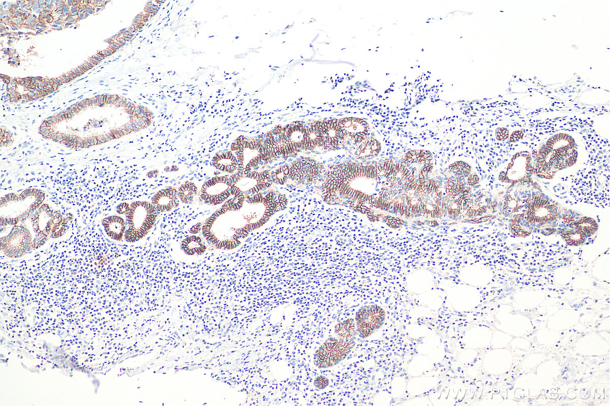 Immunohistochemistry (IHC) staining of human breast cancer tissue using E-cadherin Monoclonal antibody (60335-1-Ig)