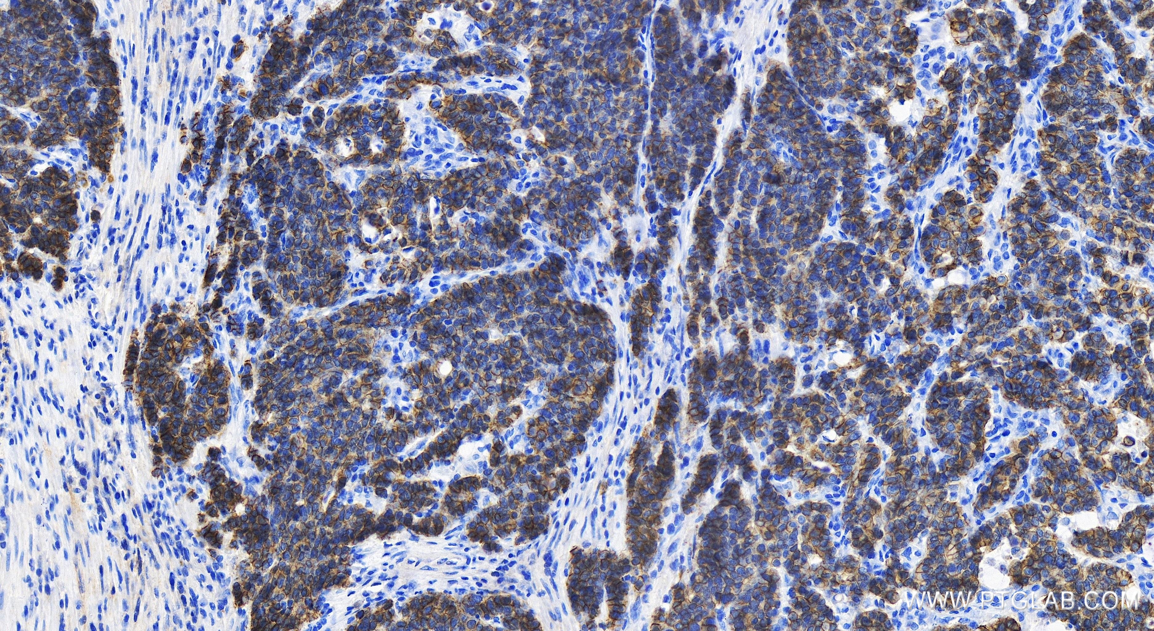 Immunohistochemistry (IHC) staining of human stomach cancer tissue using E-cadherin Recombinant antibody (80541-5-RR)