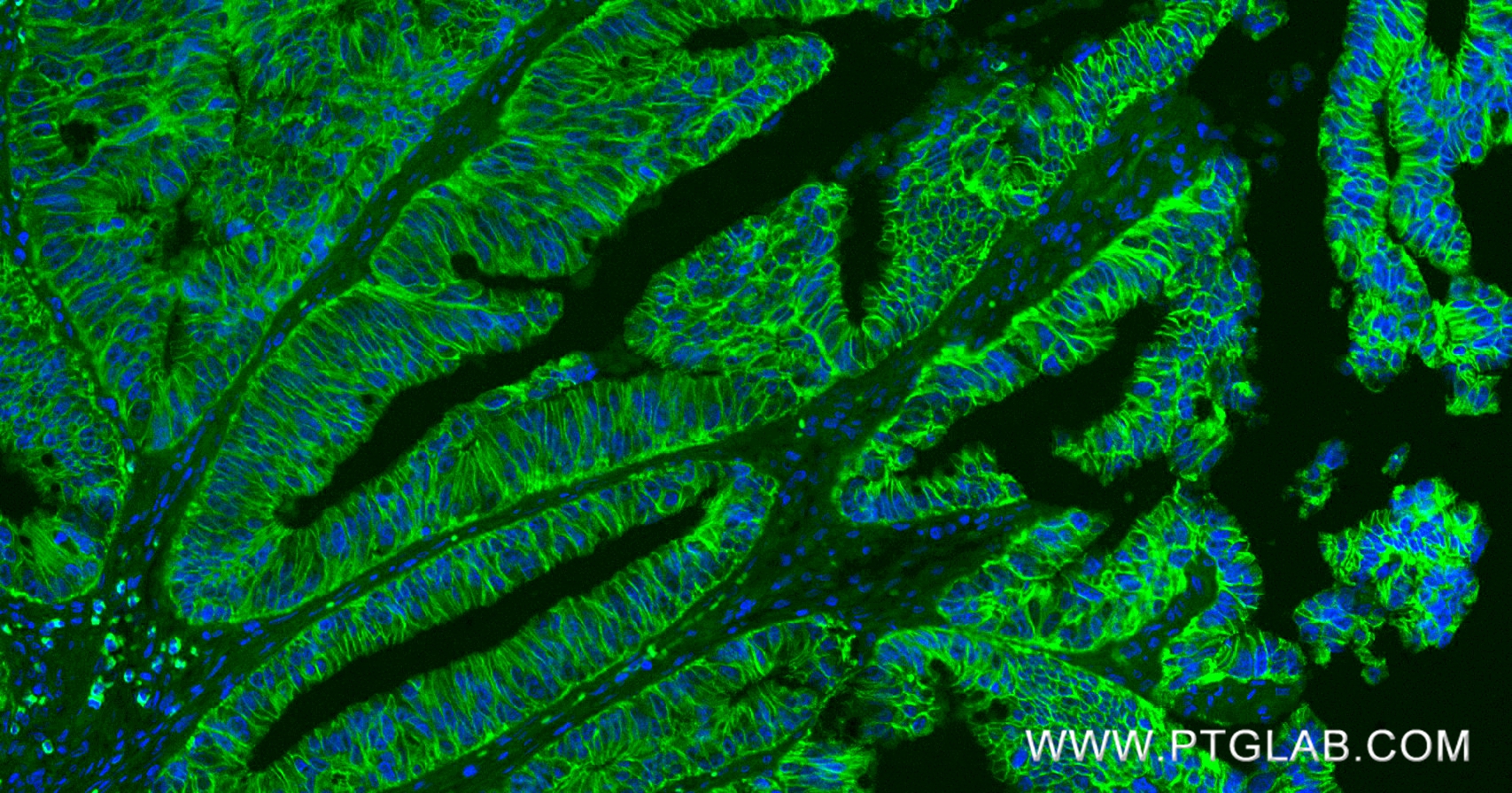 Immunofluorescence (IF) / fluorescent staining of human colon cancer tissue using E-cadherin Recombinant monoclonal antibody (80541-7-RR)