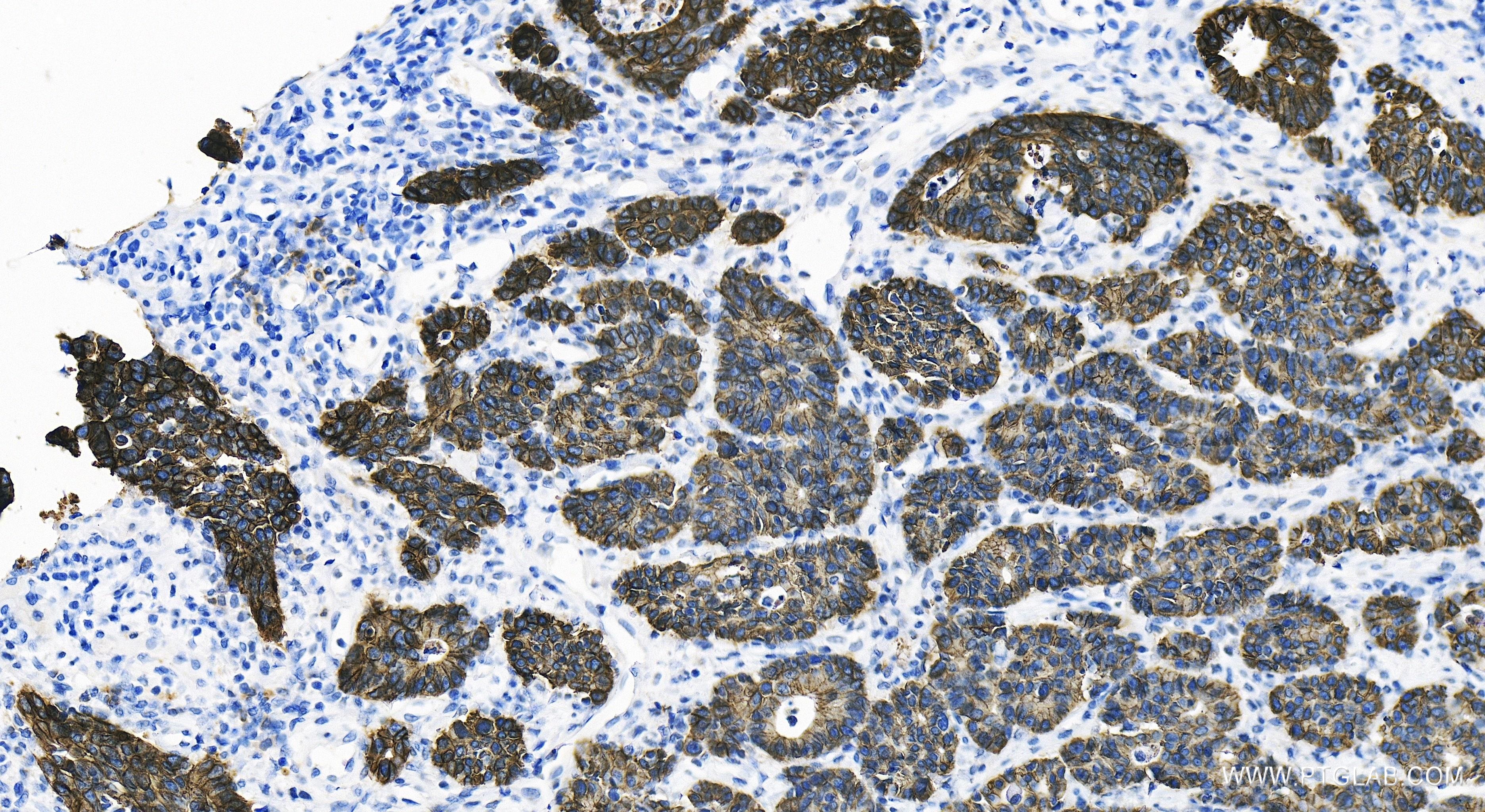 Immunohistochemistry (IHC) staining of human stomach cancer tissue using E-cadherin Recombinant antibody (80541-7-RR)