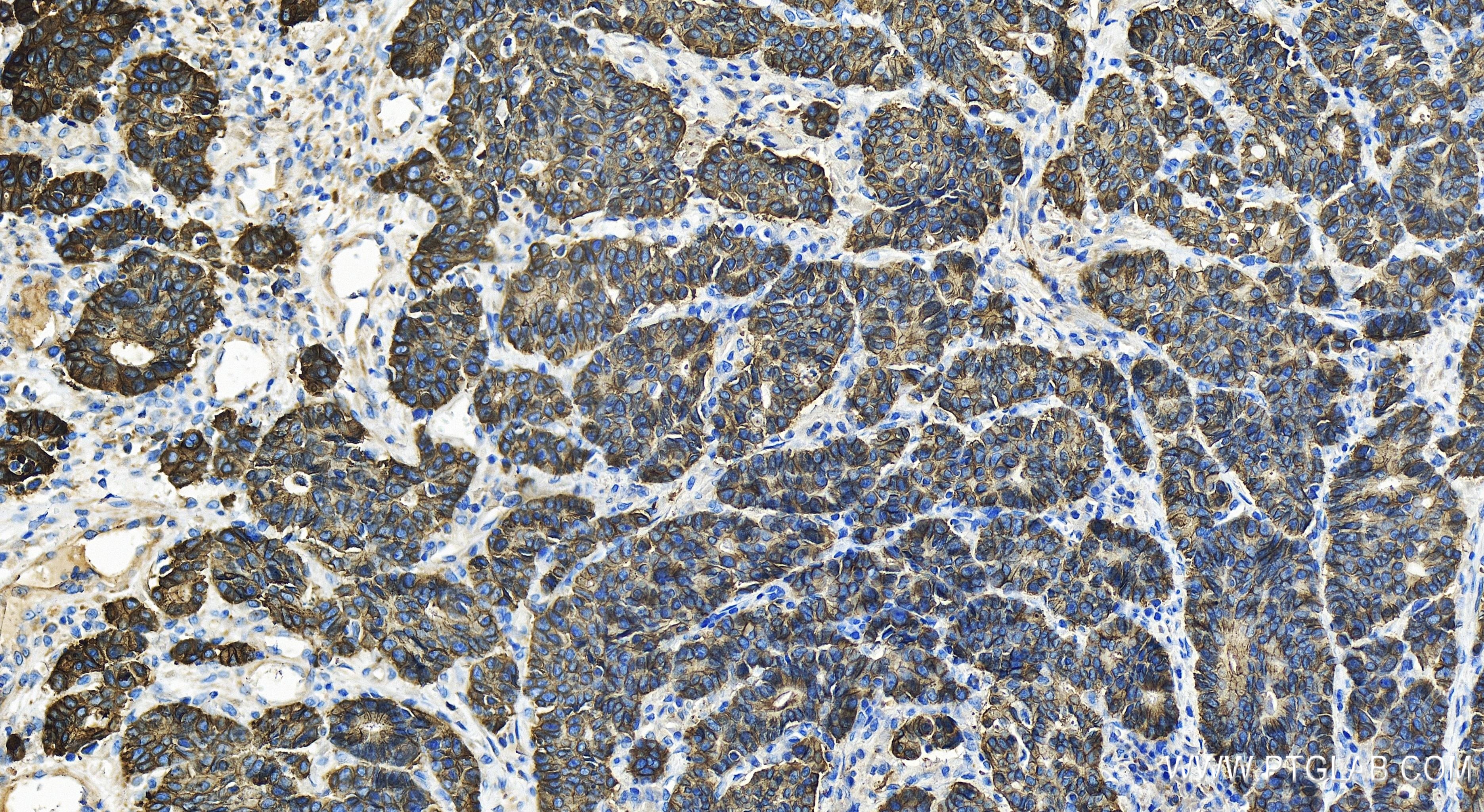 Immunohistochemistry (IHC) staining of human stomach cancer tissue using E-cadherin Recombinant antibody (80541-9-RR)