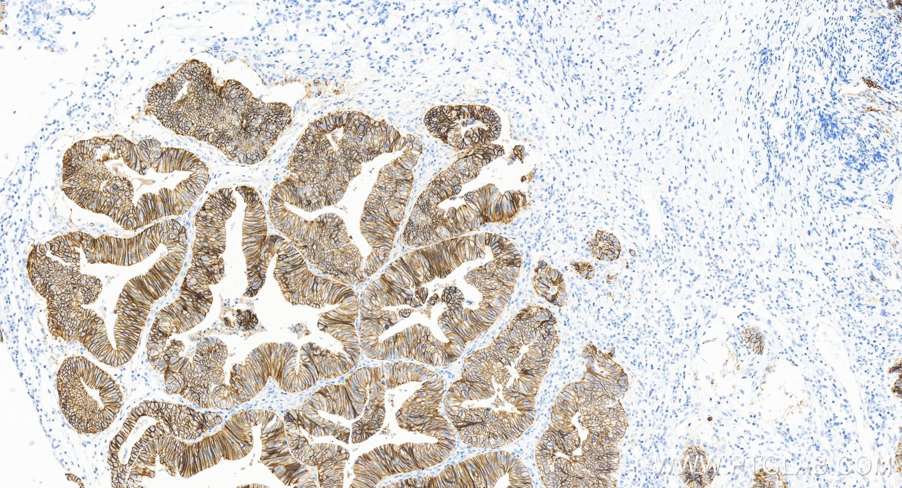 Immunohistochemistry (IHC) staining of human colon cancer tissue using E-cadherin Recombinant antibody (83991-4-RR)