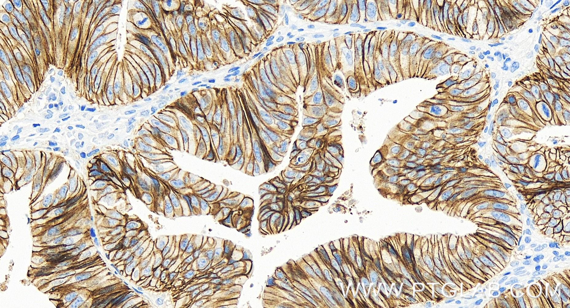 Immunohistochemistry (IHC) staining of human colon cancer tissue using E-cadherin Recombinant antibody (83991-4-RR)