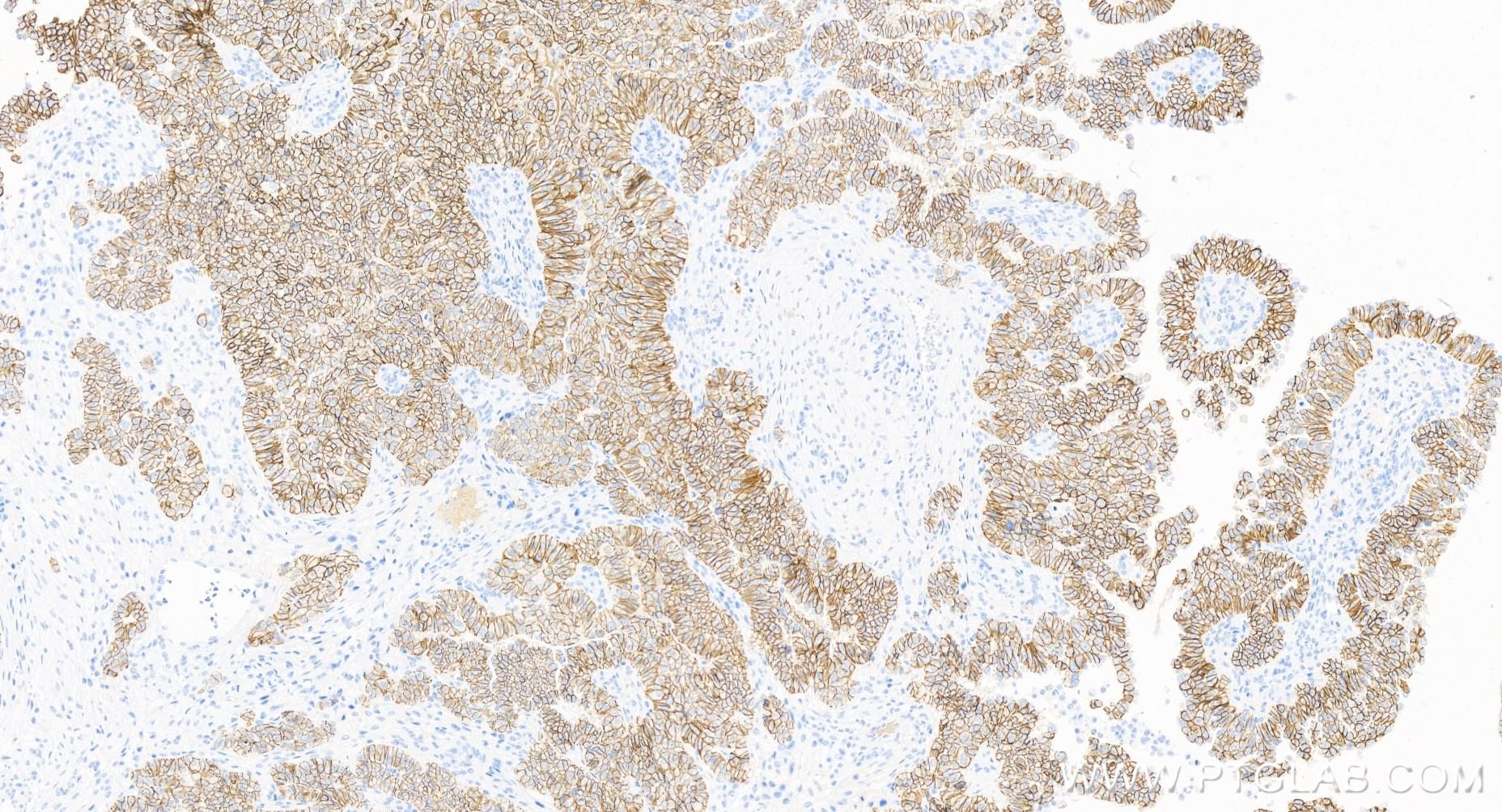 Immunohistochemistry (IHC) staining of human ovary cancer tissue using E-cadherin Recombinant antibody (83991-4-RR)