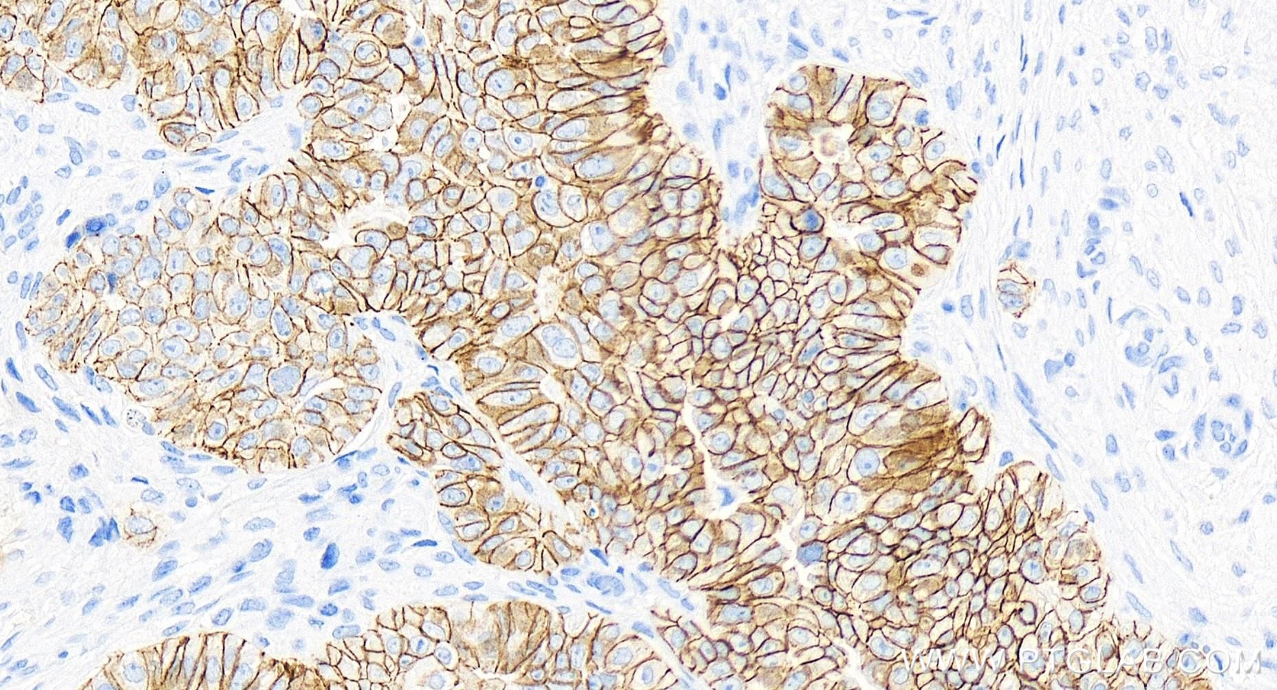 Immunohistochemistry (IHC) staining of human ovary cancer tissue using E-cadherin Recombinant antibody (83991-4-RR)