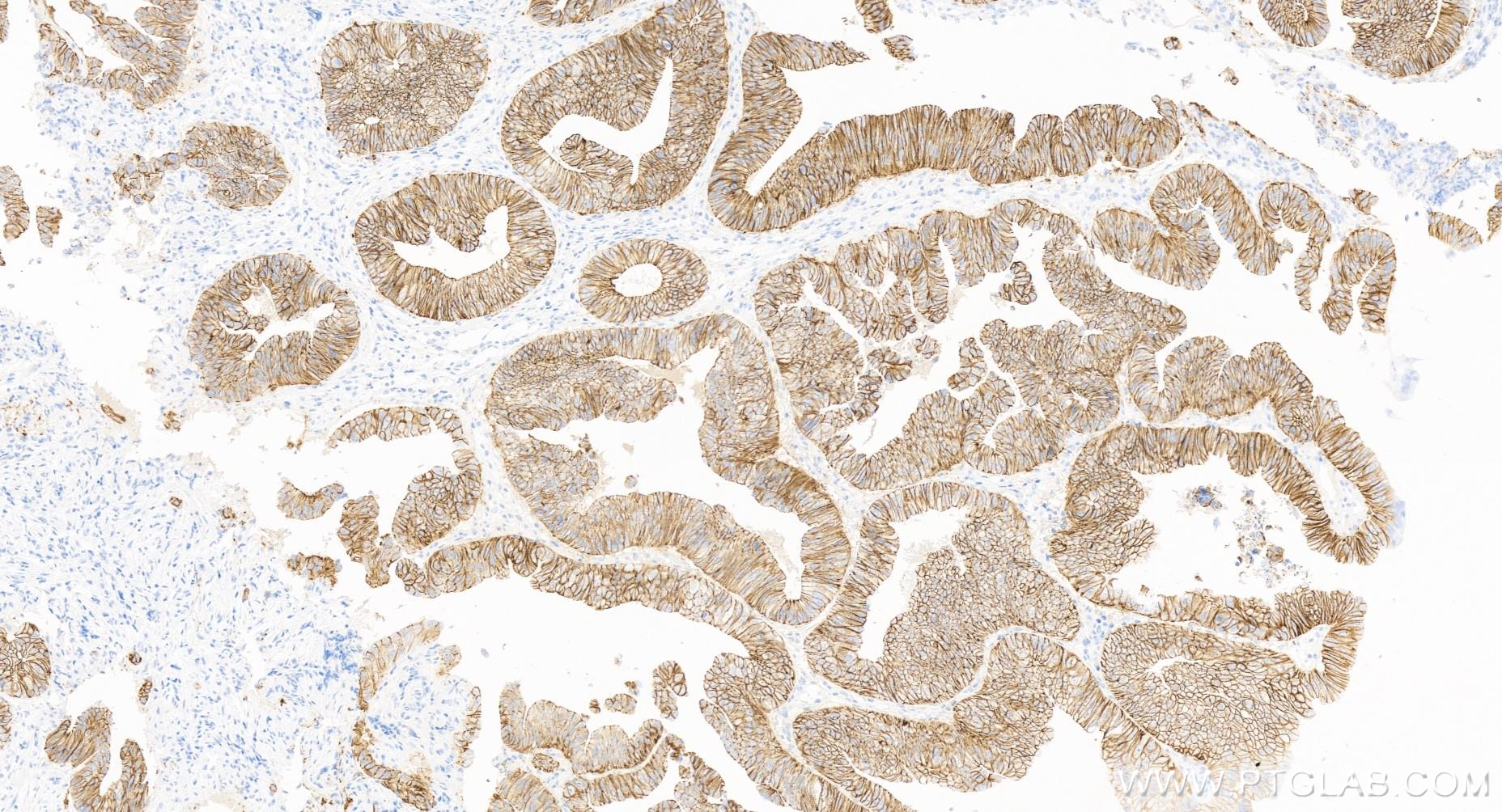 Immunohistochemistry (IHC) staining of human colon cancer tissue using E-cadherin Recombinant antibody (83991-4-RR)