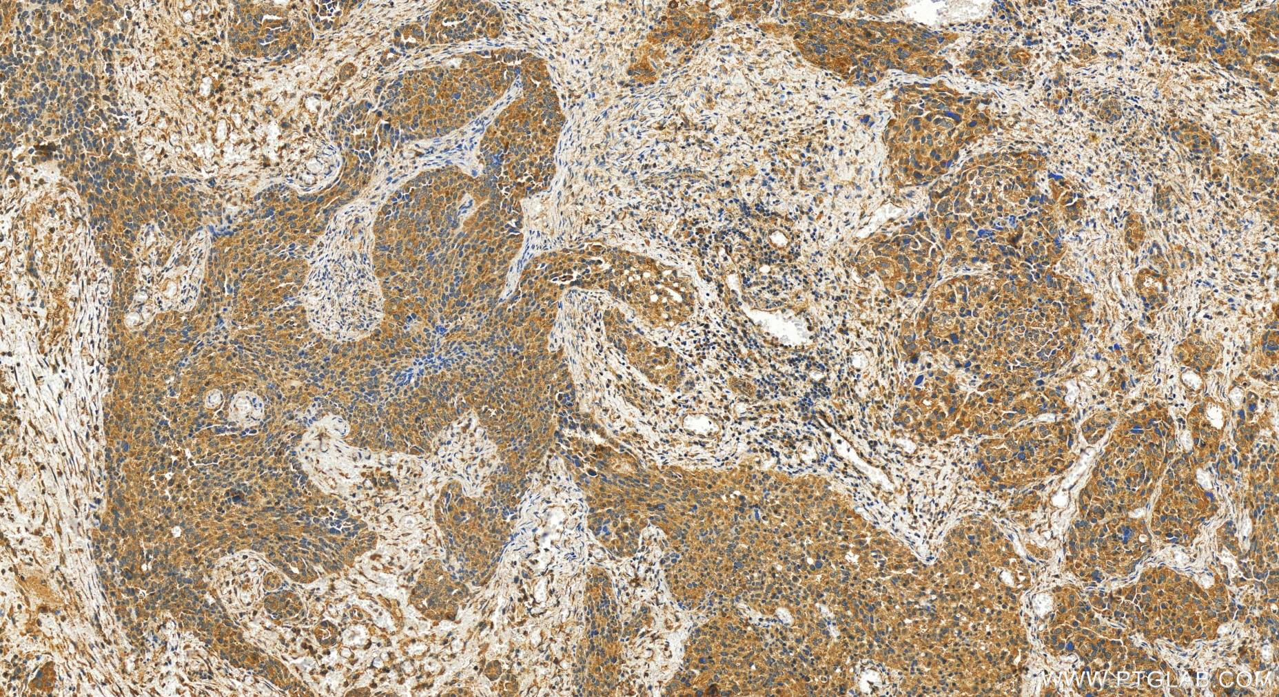 Immunohistochemistry (IHC) staining of human ovary cancer tissue using ECD Polyclonal antibody (10192-1-AP)