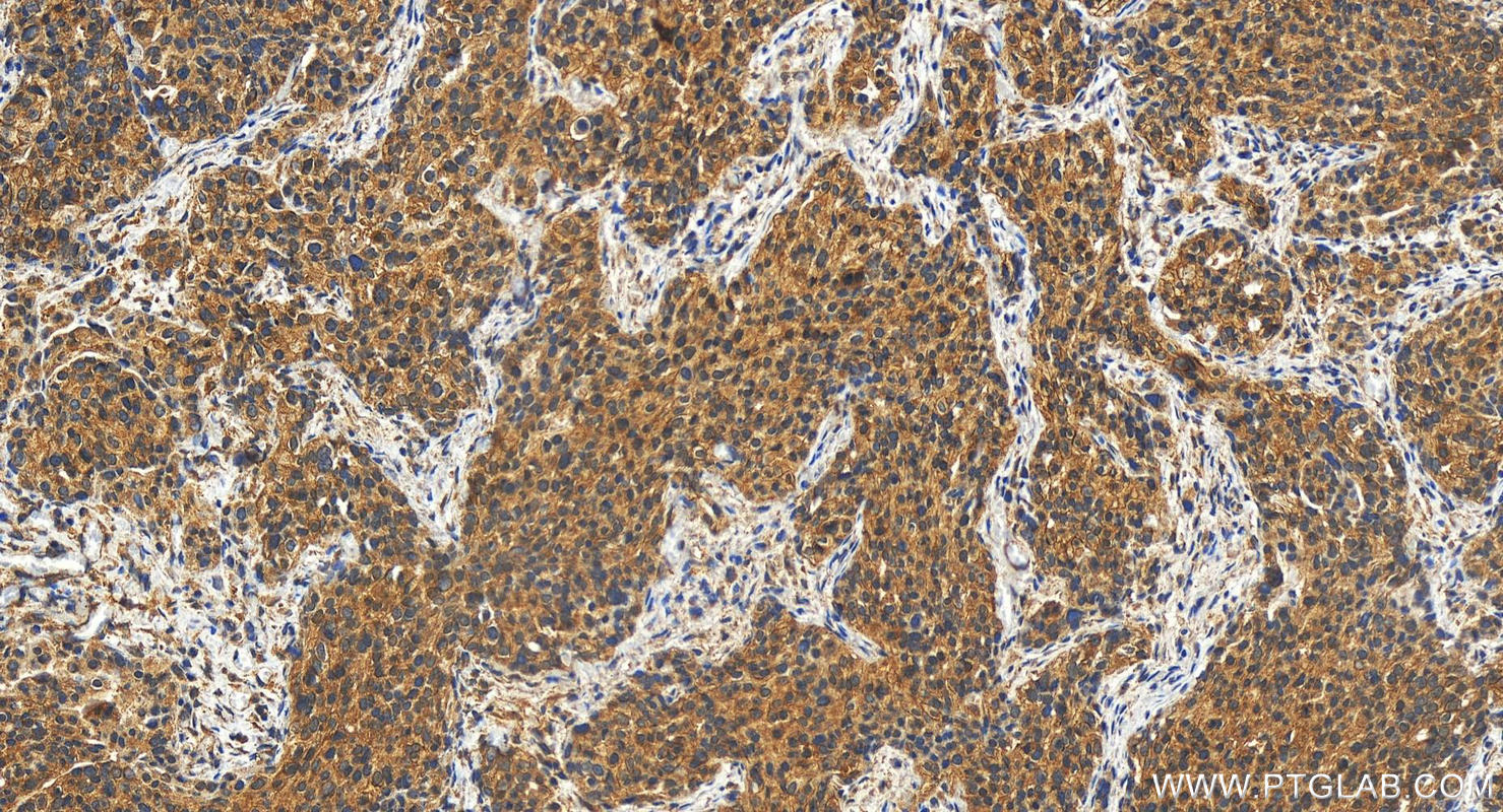 Immunohistochemistry (IHC) staining of human ovary cancer tissue using ECHDC3 Polyclonal antibody (27098-1-AP)