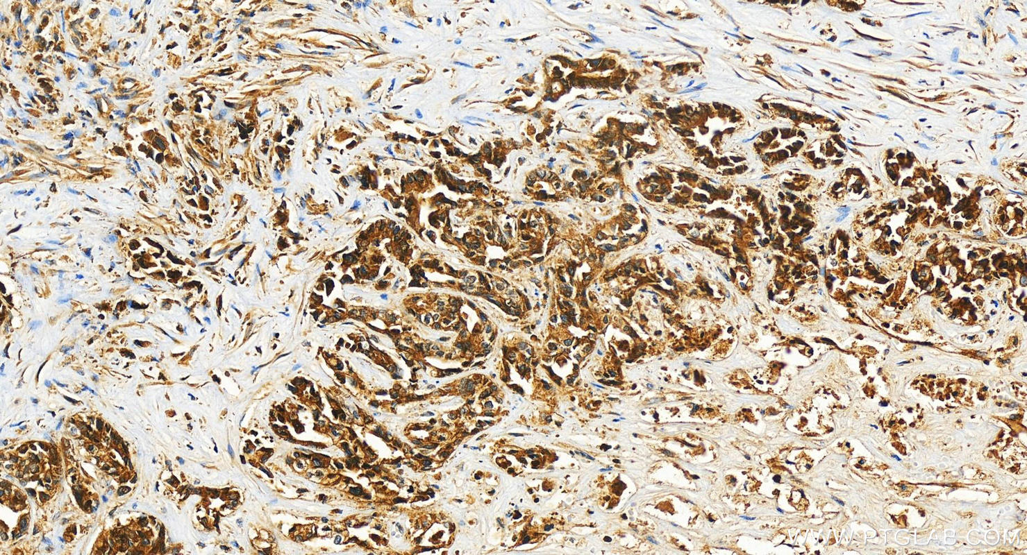 Immunohistochemistry (IHC) staining of human intrahepatic cholangiocarcinoma tissue using ECSIT Recombinant antibody (83295-1-RR)