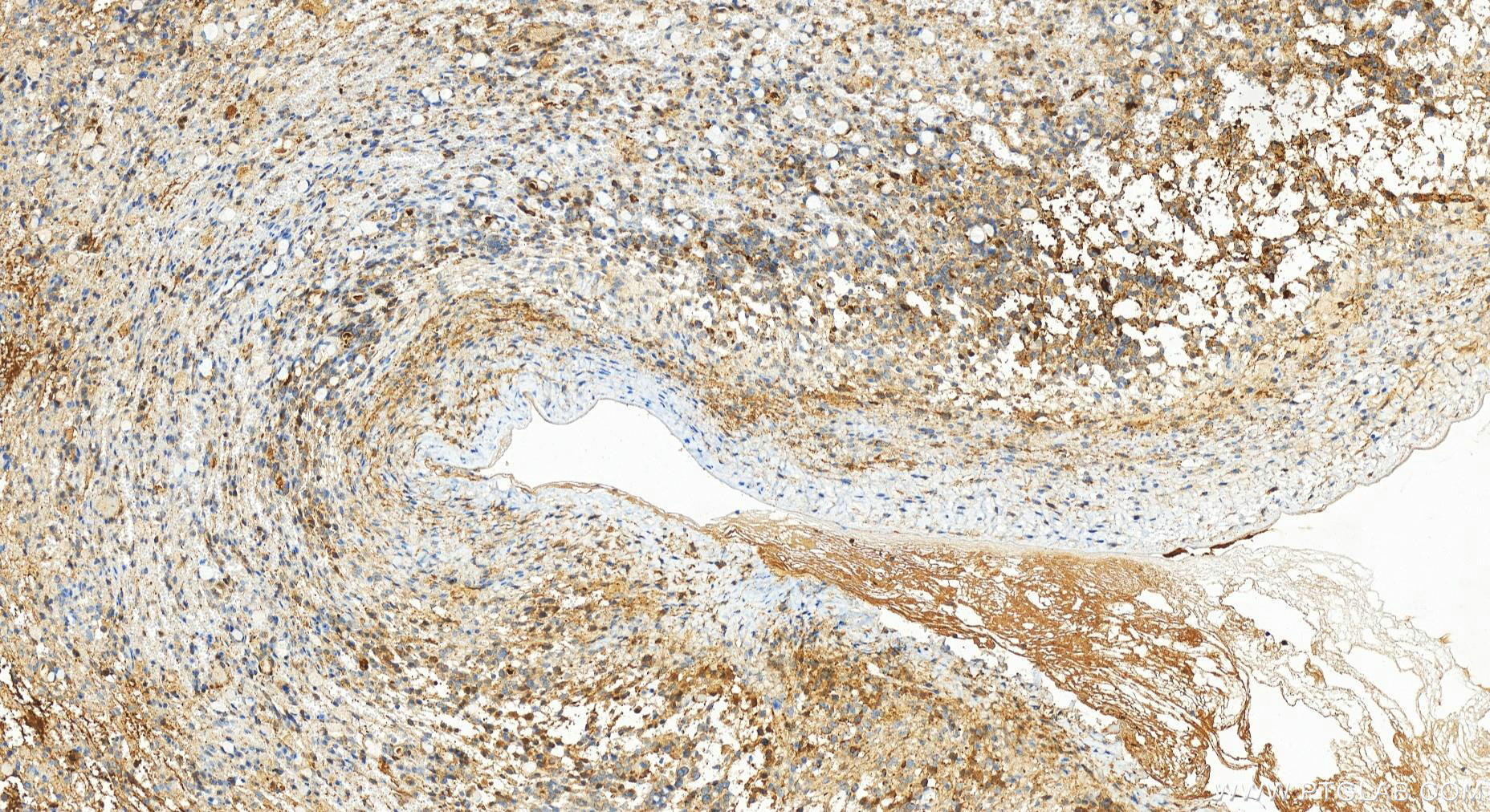 Immunohistochemistry (IHC) staining of human ovary cancer tissue using ECSIT Recombinant antibody (83295-1-RR)