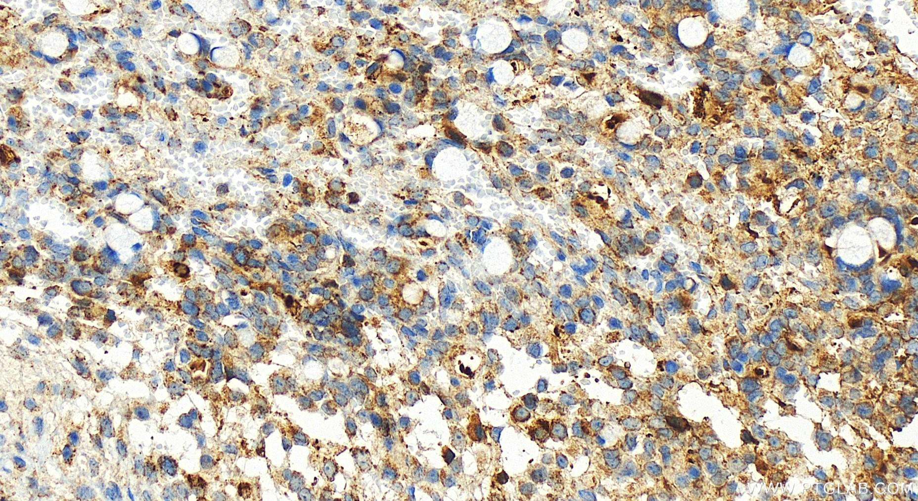 Immunohistochemistry (IHC) staining of human ovary cancer tissue using ECSIT Recombinant antibody (83295-1-RR)