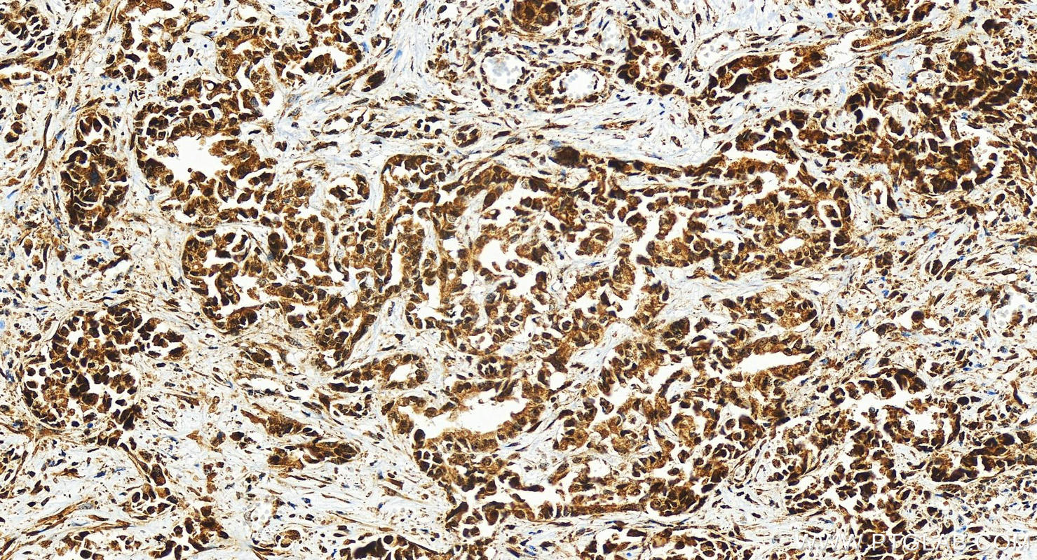 Immunohistochemistry (IHC) staining of human intrahepatic cholangiocarcinoma tissue using ECSIT Recombinant antibody (83295-5-RR)