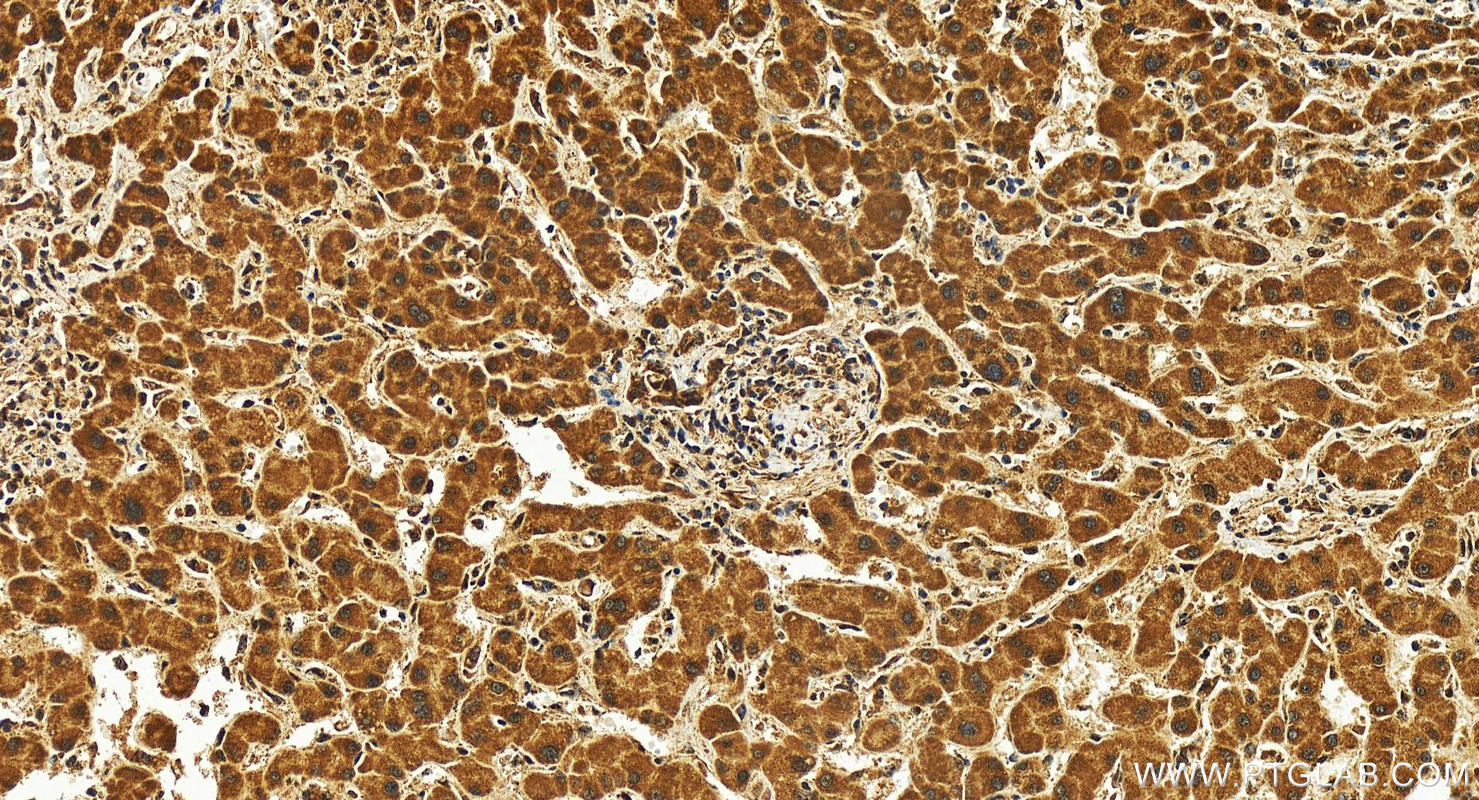 Immunohistochemistry (IHC) staining of human intrahepatic cholangiocarcinoma tissue using ECSIT Recombinant antibody (83295-5-RR)