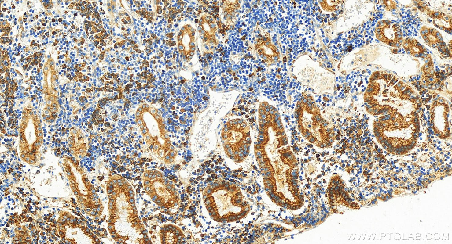 Immunohistochemistry (IHC) staining of human stomach cancer tissue using EDEM3 Polyclonal antibody (27310-1-AP)