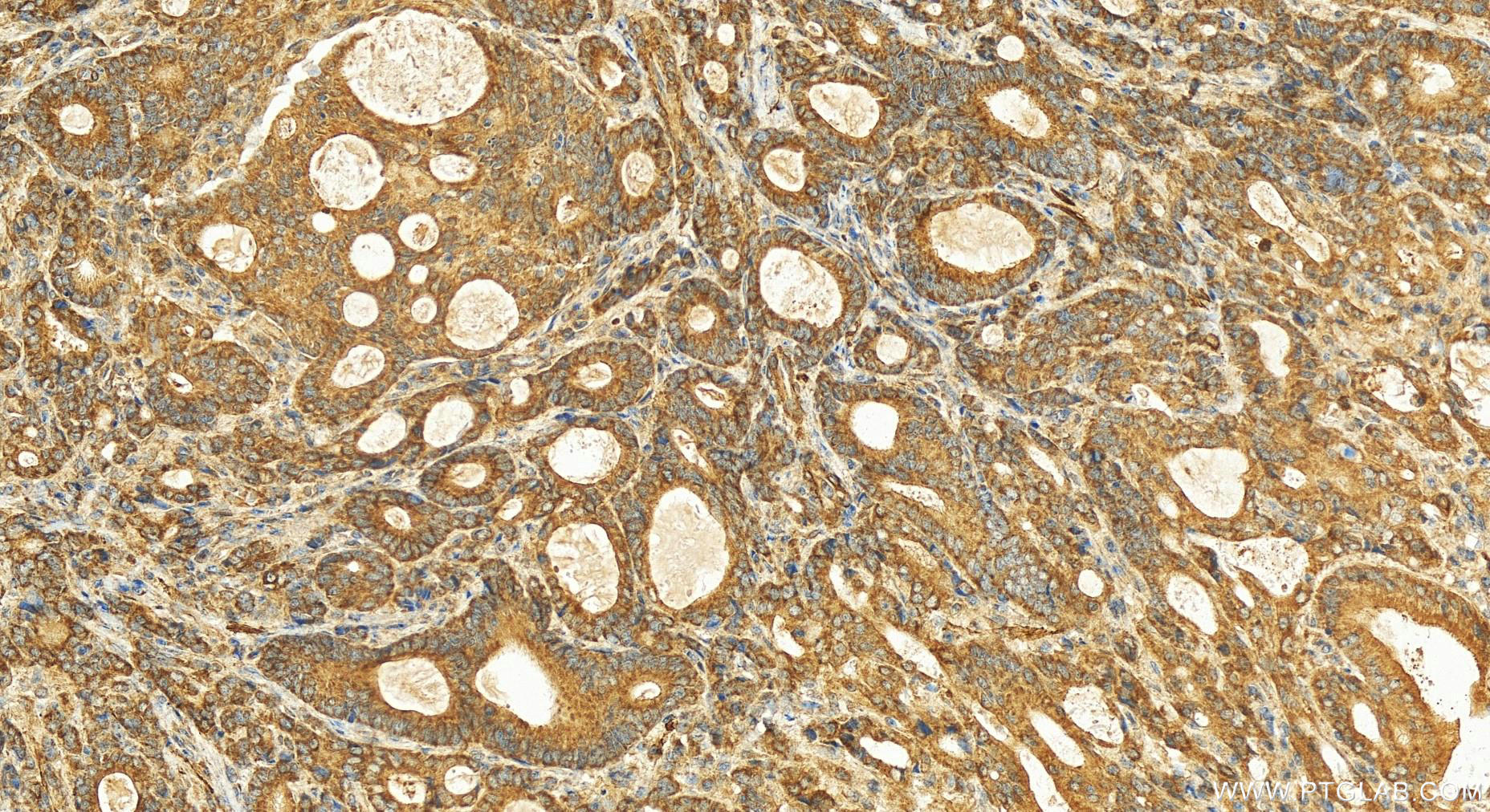 Immunohistochemistry (IHC) staining of human stomach cancer tissue using MICU2 Polyclonal antibody (20859-1-AP)