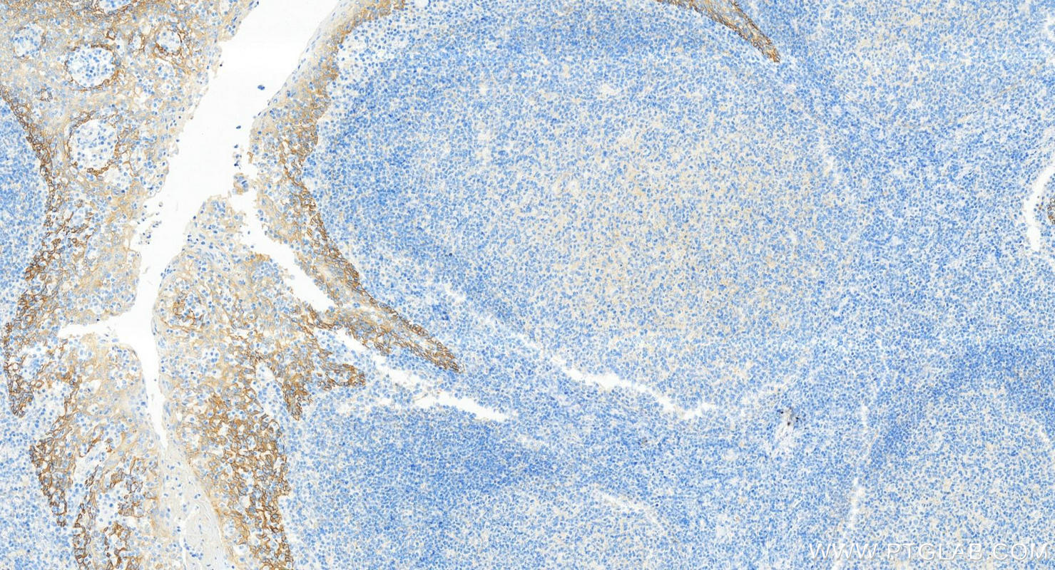 Immunohistochemistry (IHC) staining of human tonsillitis tissue using EGFR Monoclonal antibody (66455-1-Ig)