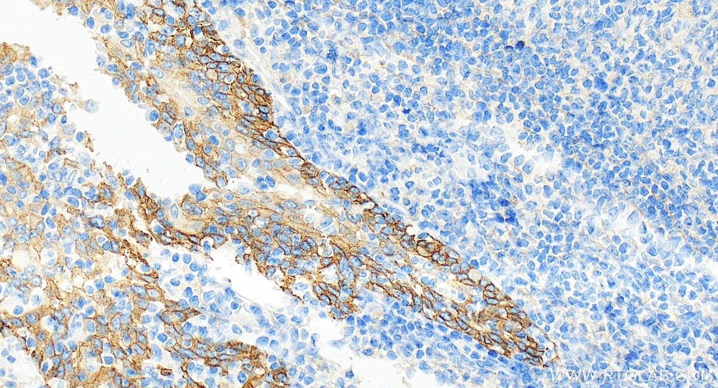 Immunohistochemistry (IHC) staining of human tonsillitis tissue using EGFR Monoclonal antibody (66455-1-Ig)