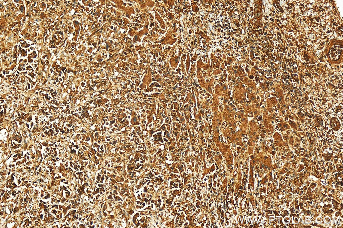 Immunohistochemistry (IHC) staining of human intrahepatic cholangiocarcinoma tissue using EHD4 Polyclonal antibody (11382-2-AP)