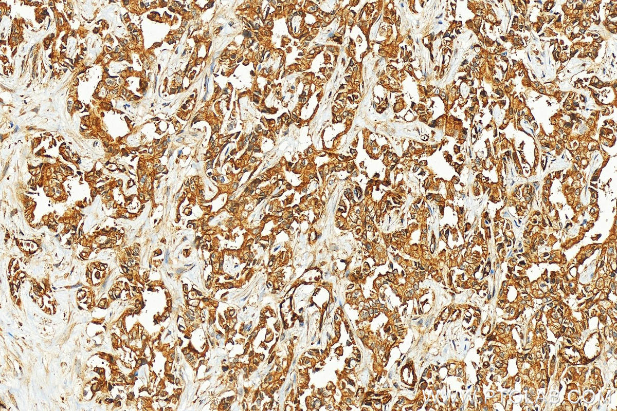 Immunohistochemistry (IHC) staining of human intrahepatic cholangiocarcinoma tissue using EHD4 Polyclonal antibody (11382-2-AP)