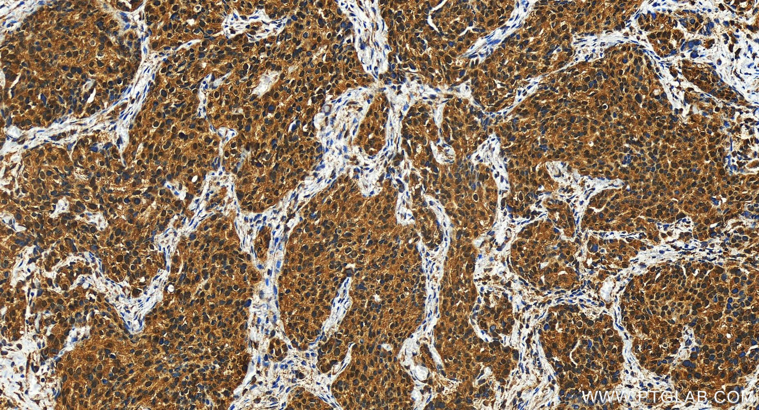 Immunohistochemistry (IHC) staining of human ovary cancer tissue using EHF Polyclonal antibody (27195-1-AP)