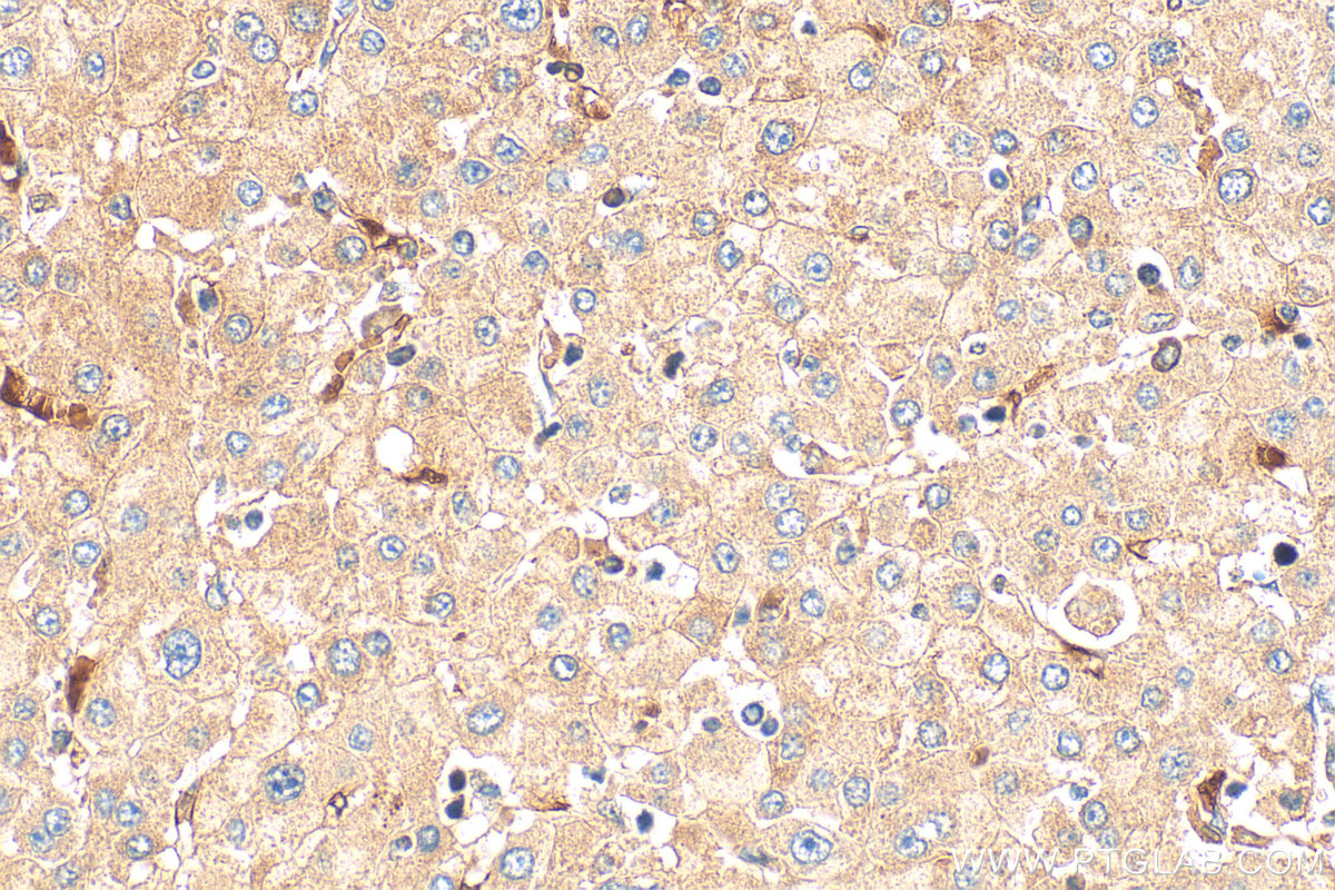 Immunohistochemistry (IHC) staining of human liver cancer tissue using PERK/EIF2AK3 Polyclonal antibody (24390-1-AP)
