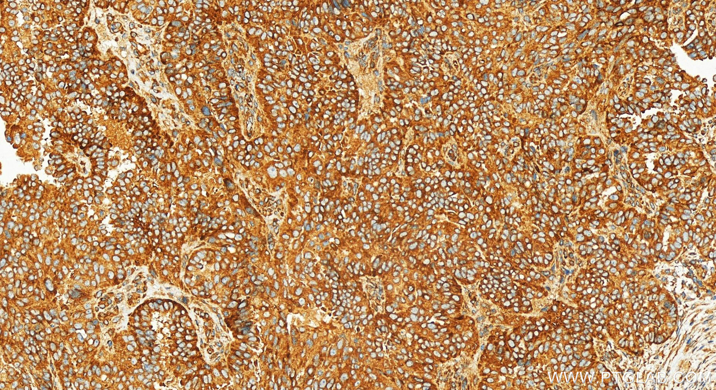 Immunohistochemistry (IHC) staining of human ovarian  cancer using EIF2S1 Recombinant antibody (82936-8-RR)