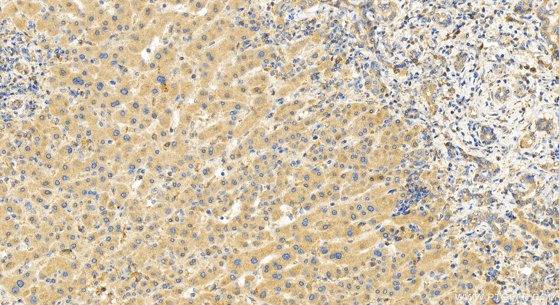 Immunohistochemistry (IHC) staining of human intrahepatic cholangiocarcinoma tissue using EIF3A Polyclonal antibody (26178-1-AP)