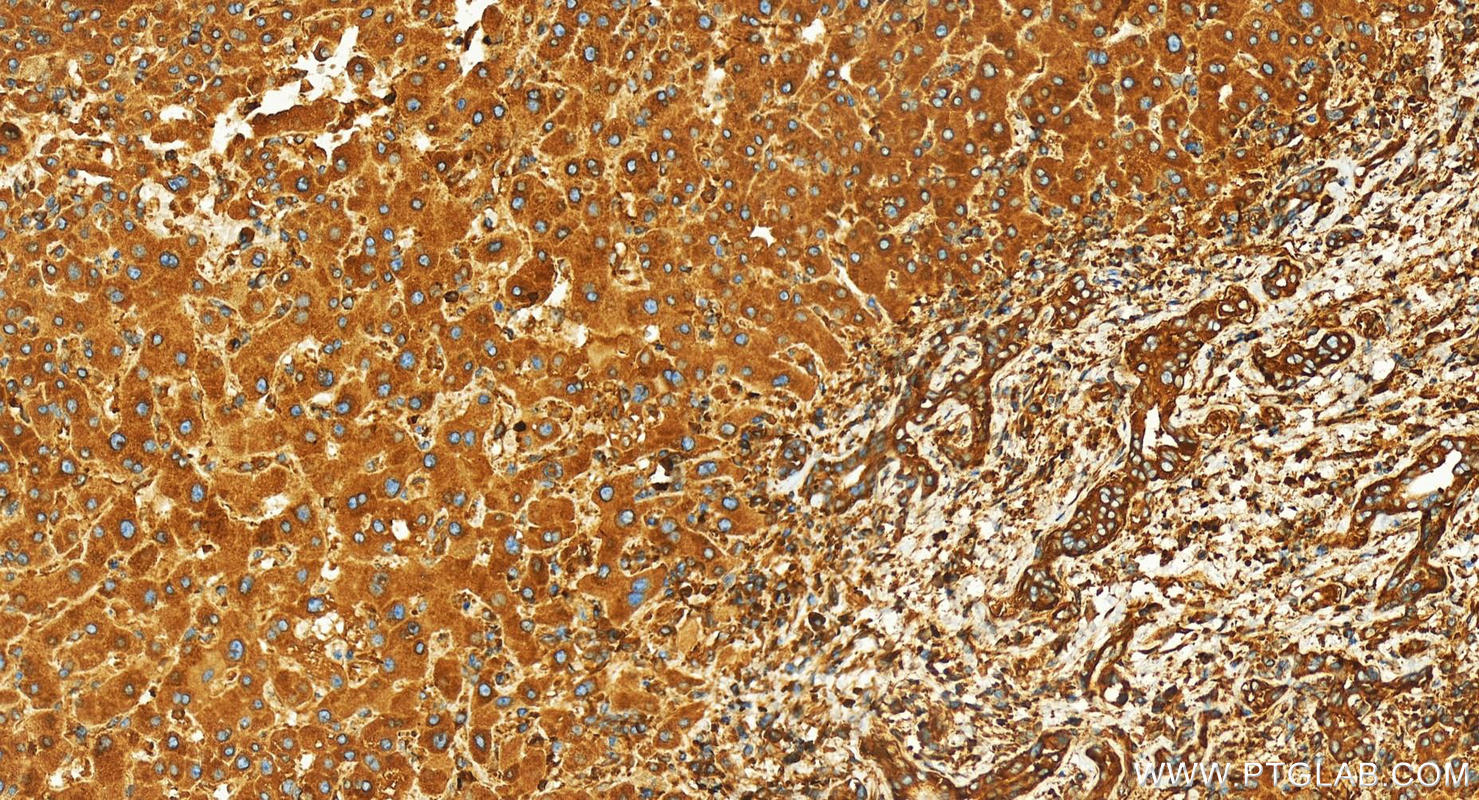 Immunohistochemistry (IHC) staining of human intrahepatic cholangiocarcinoma tissue using EIF3A Polyclonal antibody (26178-1-AP)