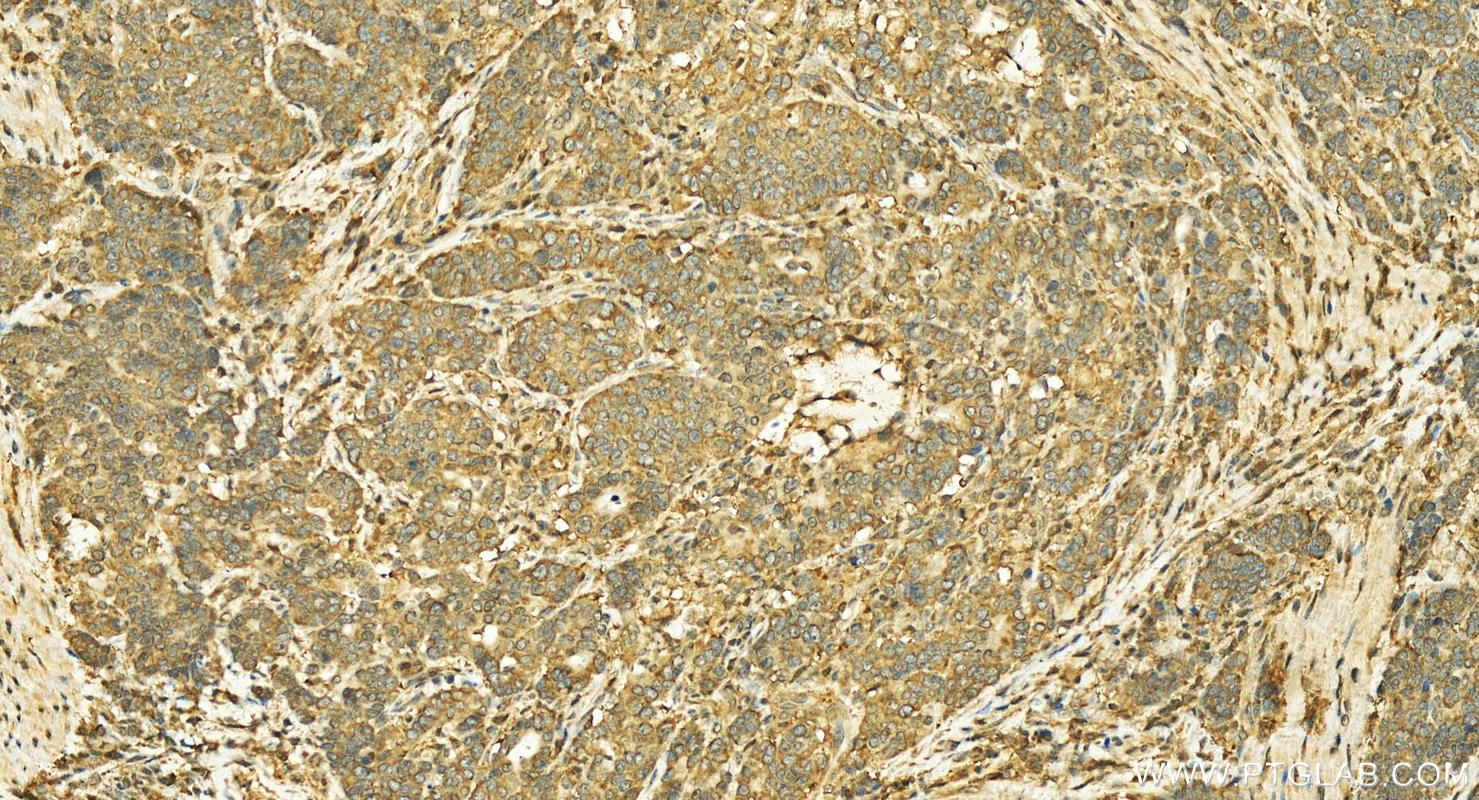 Immunohistochemistry (IHC) staining of human stomach cancer tissue using EIF3C Polyclonal antibody (12733-1-AP)