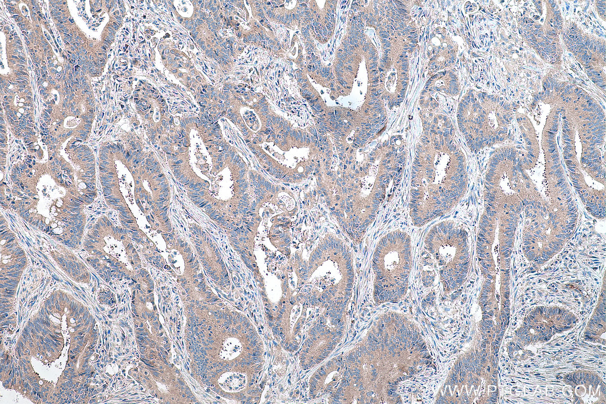 Immunohistochemistry (IHC) staining of human colon cancer tissue using EIF3G Polyclonal antibody (11165-1-AP)