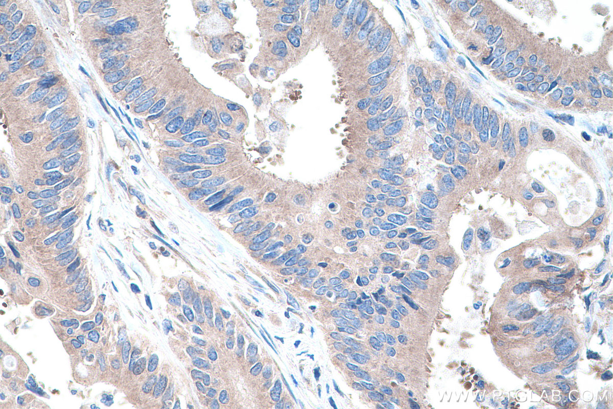 Immunohistochemistry (IHC) staining of human colon cancer tissue using EIF3G Polyclonal antibody (11165-1-AP)