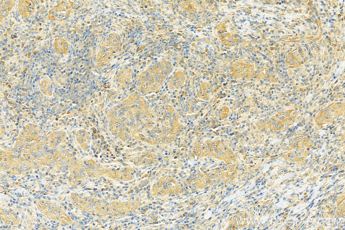 Immunohistochemistry (IHC) staining of human skin cancer tissue using eIF4G2/DAP5 Polyclonal antibody (17728-1-AP)