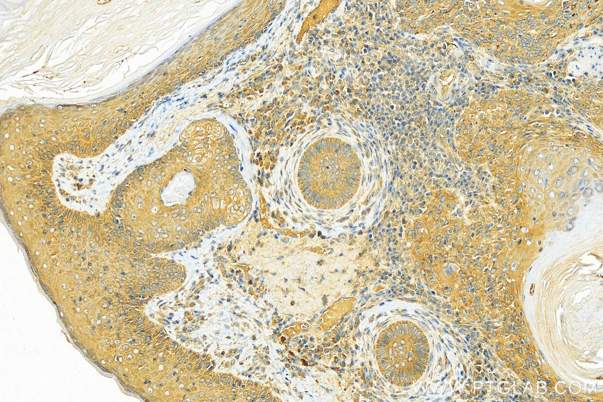 Immunohistochemistry (IHC) staining of human skin cancer tissue using eIF4G2/DAP5 Polyclonal antibody (17728-1-AP)