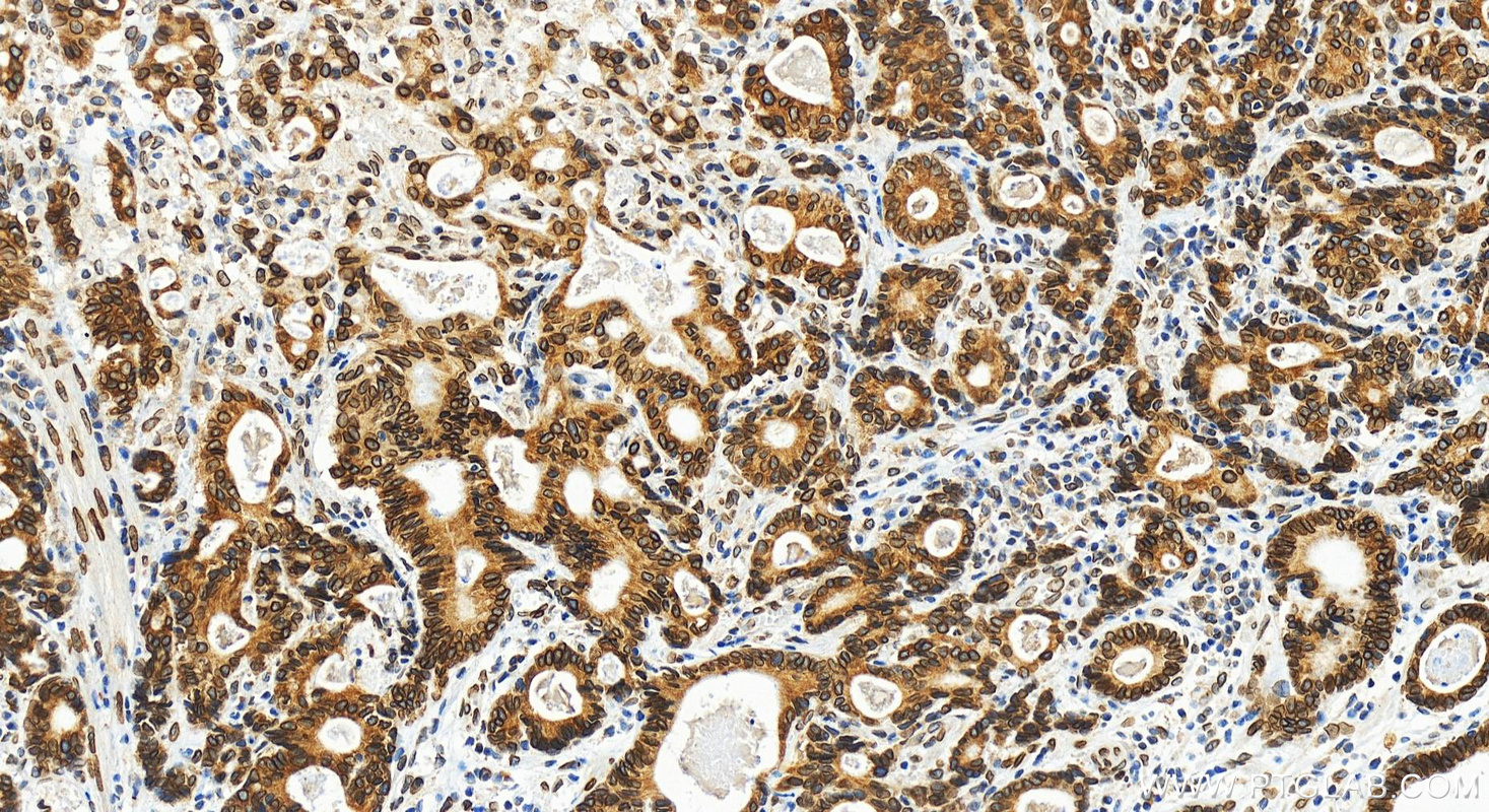 Immunohistochemistry (IHC) staining of human stomach cancer tissue using Emerin Recombinant antibody (82888-1-RR)