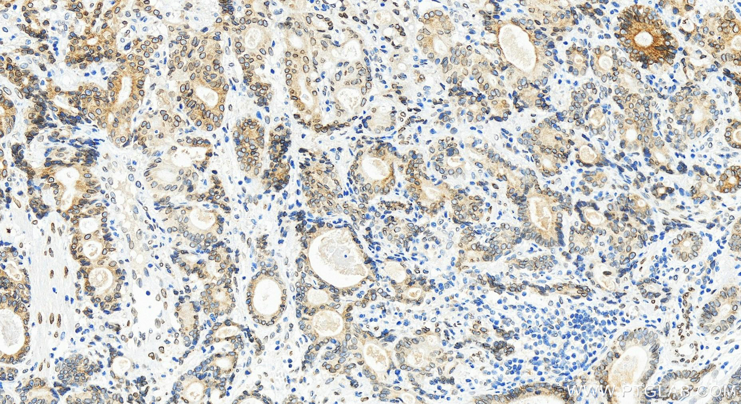 Immunohistochemistry (IHC) staining of human stomach cancer tissue using Emerin Recombinant antibody (82888-3-RR)