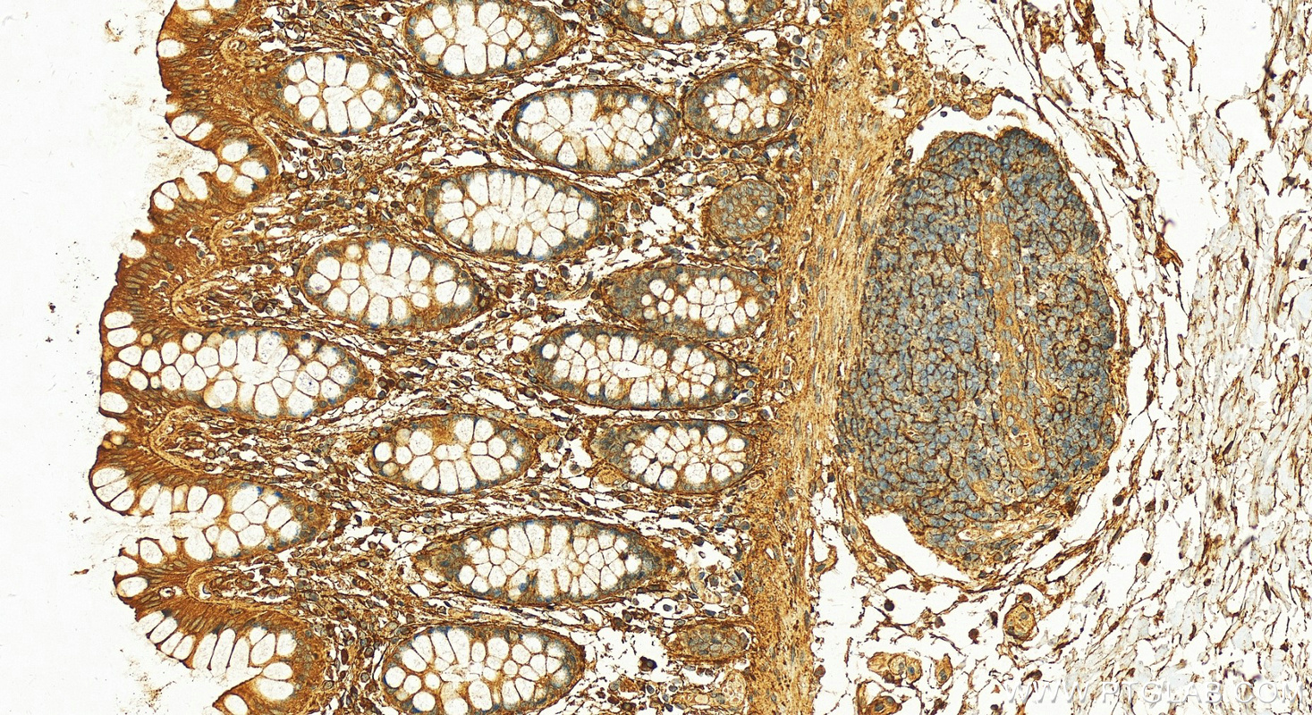 Immunohistochemistry (IHC) staining of human colon tissue using EMILIN1 Polyclonal antibody (10643-1-AP)