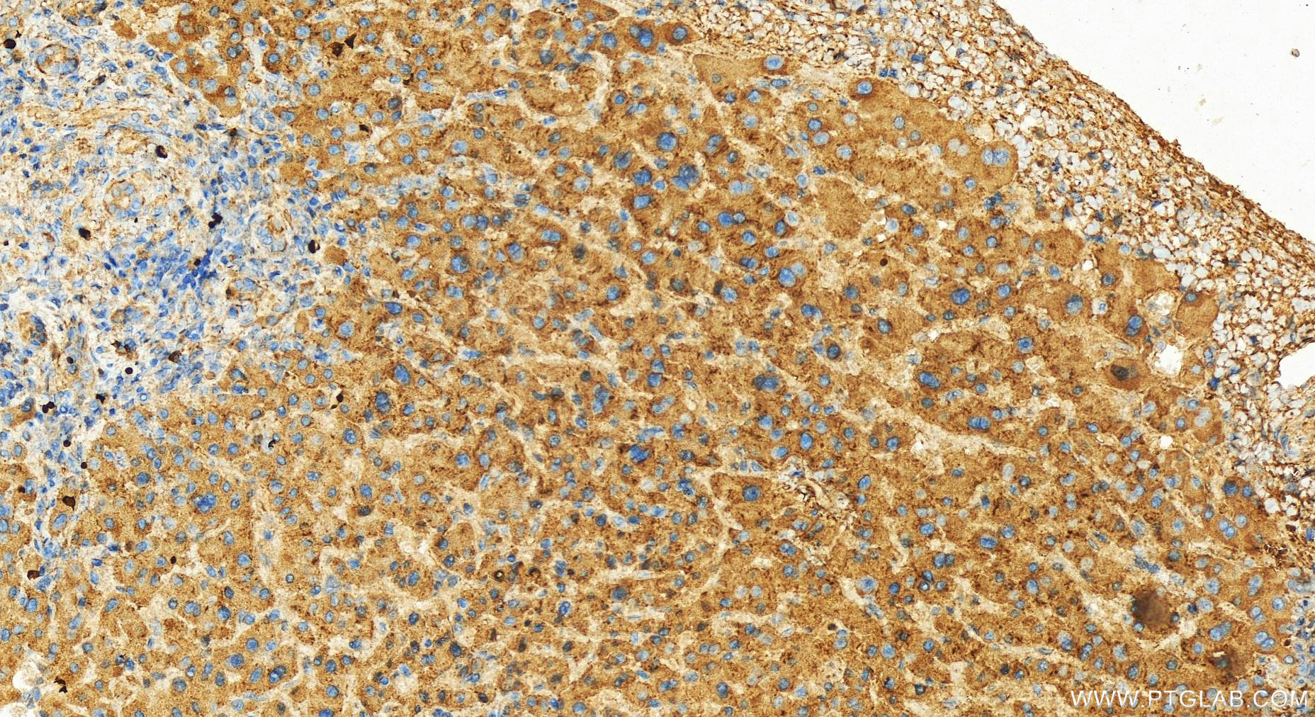 Immunohistochemistry (IHC) staining of human intrahepatic cholangiocarcinoma tissue using EML1 Polyclonal antibody (12765-1-AP)