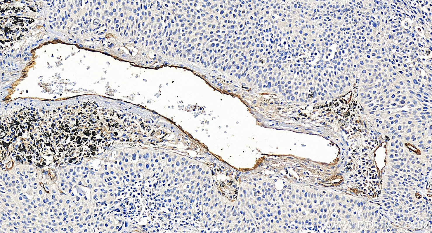 Immunohistochemistry (IHC) staining of human lung cancer tissue using Endoglin/CD105 Polyclonal antibody (10862-1-AP)