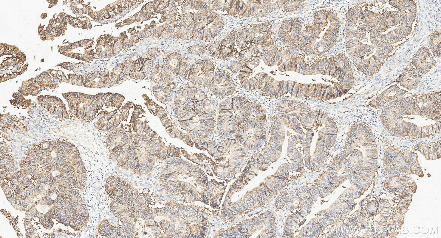 Immunohistochemistry (IHC) staining of human colorectal cancer tissue using EPCAM/CD326 Polyclonal antibody (21050-1-AP)