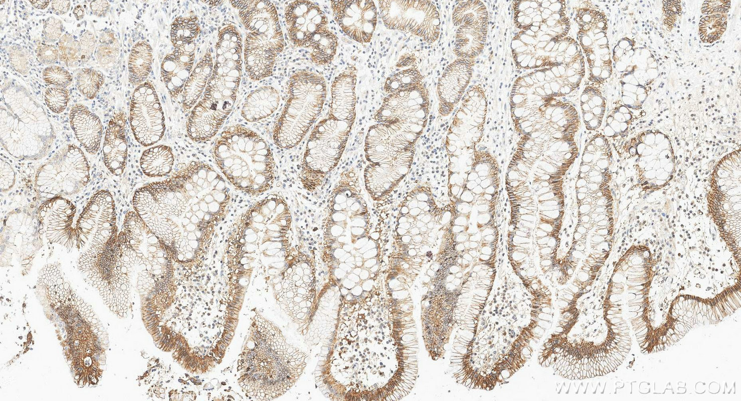 Immunohistochemistry (IHC) staining of human stomach cancer tissue using EPCAM/CD326 Polyclonal antibody (21050-1-AP)